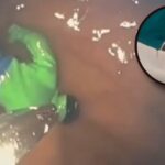 Niño tenía un fuerte dolor y médicos descubren un “Hulk” en el estómago