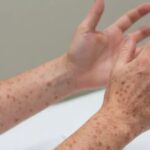 Prohíben visitas a centro de detención de migrantes en Texas por brote de sarampión